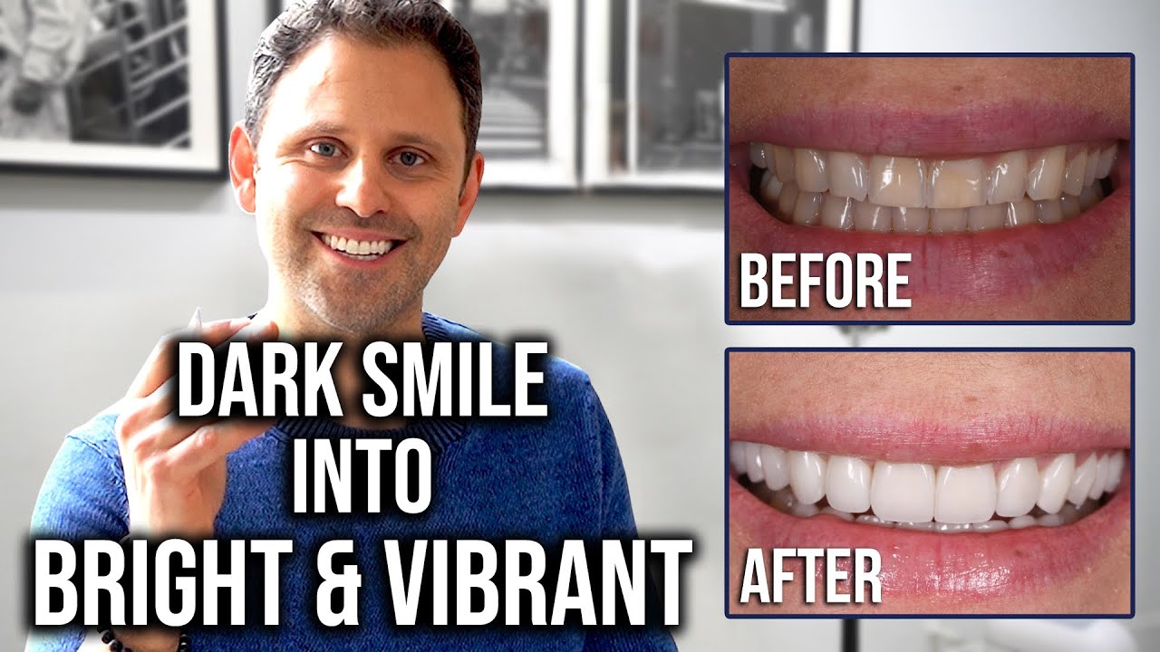 Using Porcelain Veneers To Create a Bright Smile - Dental Science