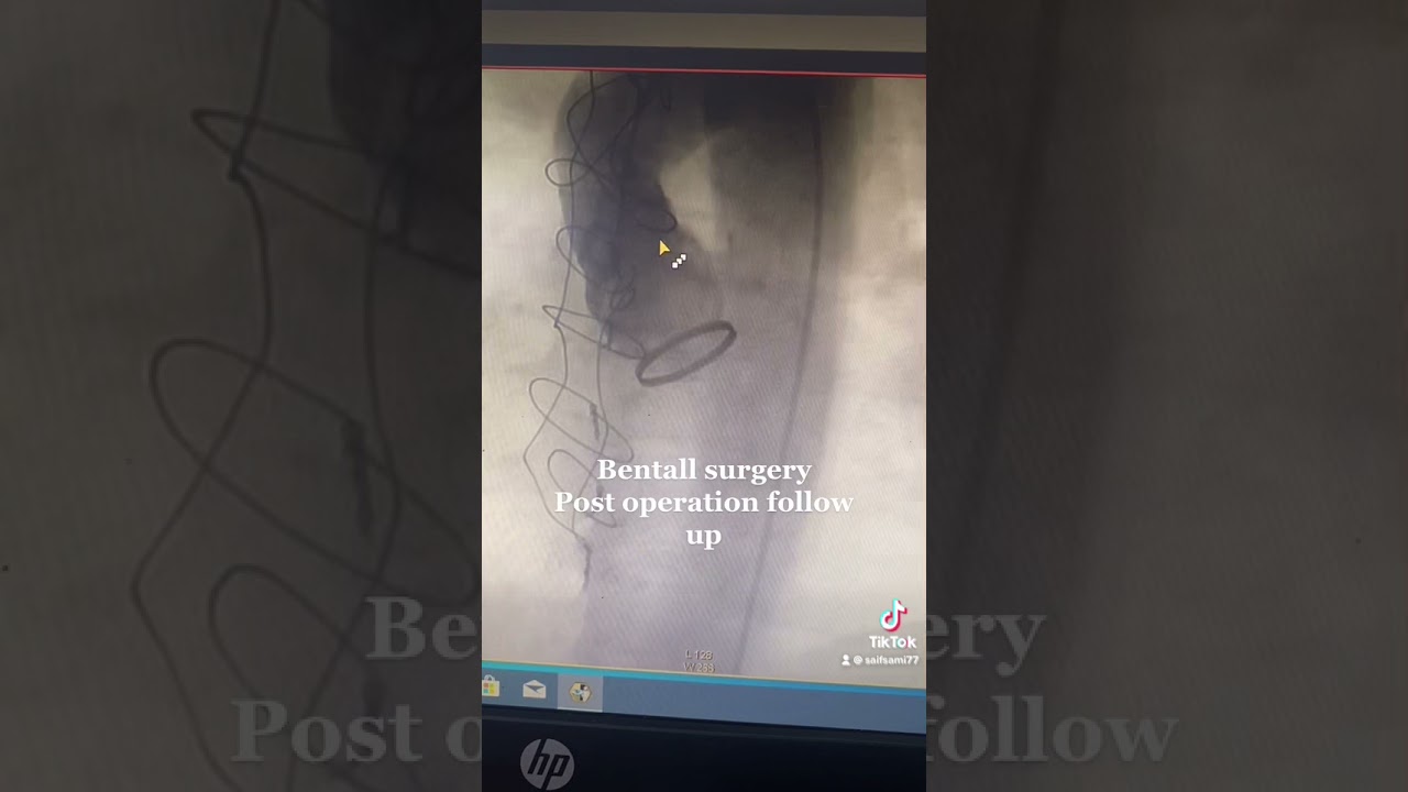 Bentall procedure