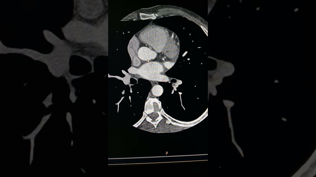 الحكم علي جوده فحص شرايين القلب المقطعيه CTA CORONARY