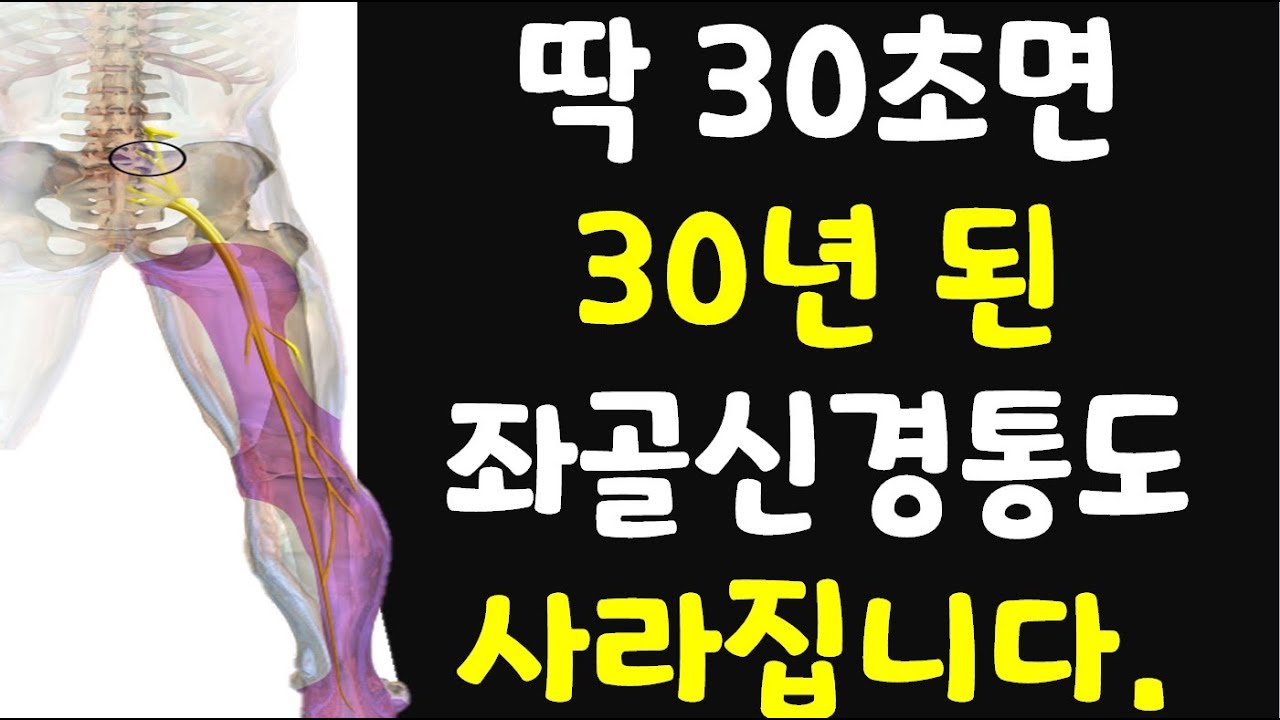30초만에 방사통 일명 좌골신경통 즉시 없애주는 기가 막히는 운동