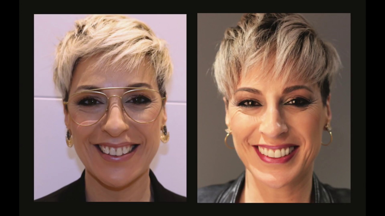 Descubre las CARILLAS DENTALES con el sistema CEREC 😃 - Puede cambiar tu vida