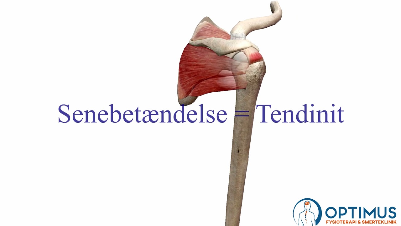 Indeklemningssyndrom (Impingement) - Hvad er det?