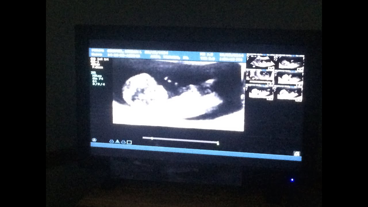 Surprise pregnancy announcement at Christmas!
