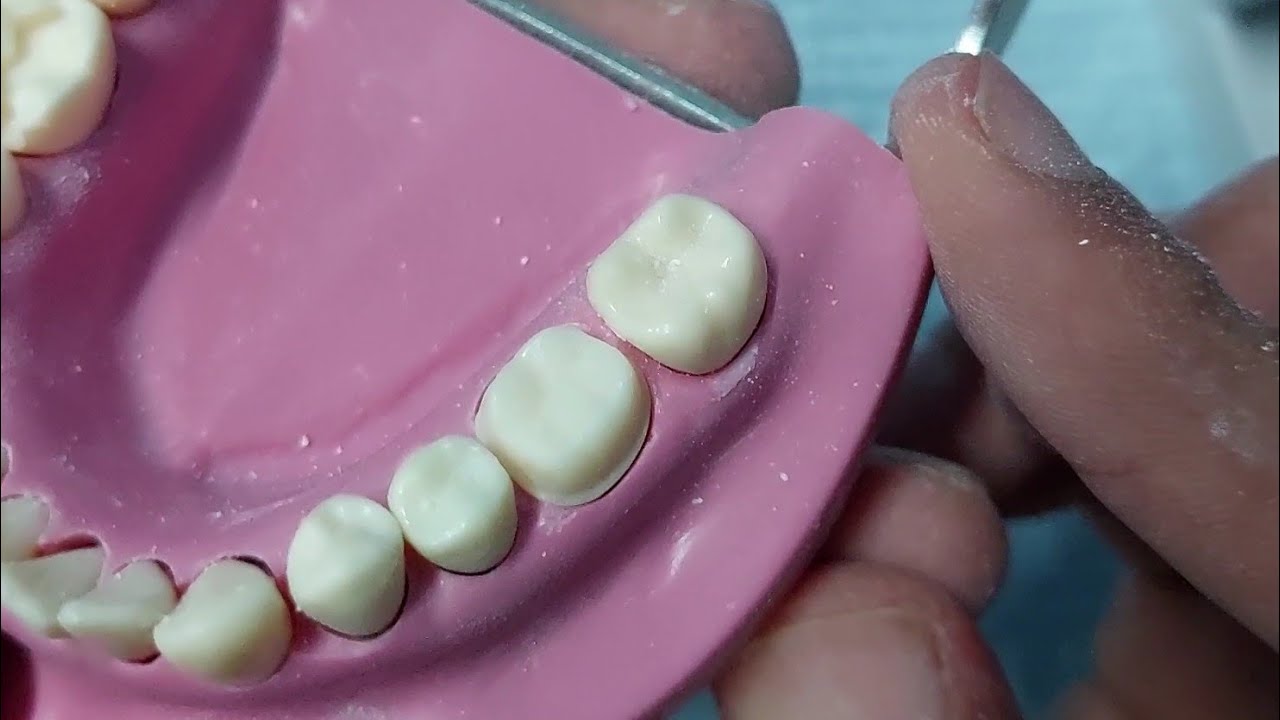 Как легко выполнить редукцию _подготовка под цельнометаллическую коронку на 6 нижних зубах #Dr_gh...