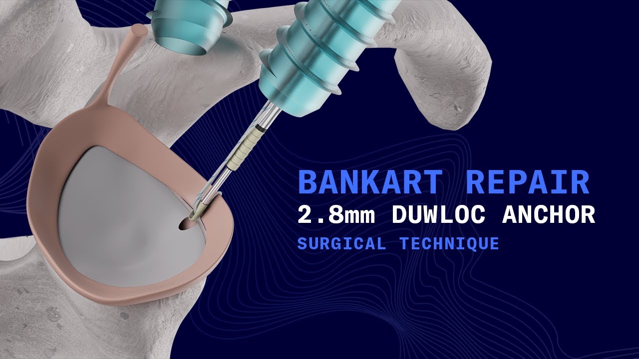 Bankart Repair 2 8mm Duwloc Anchor ST