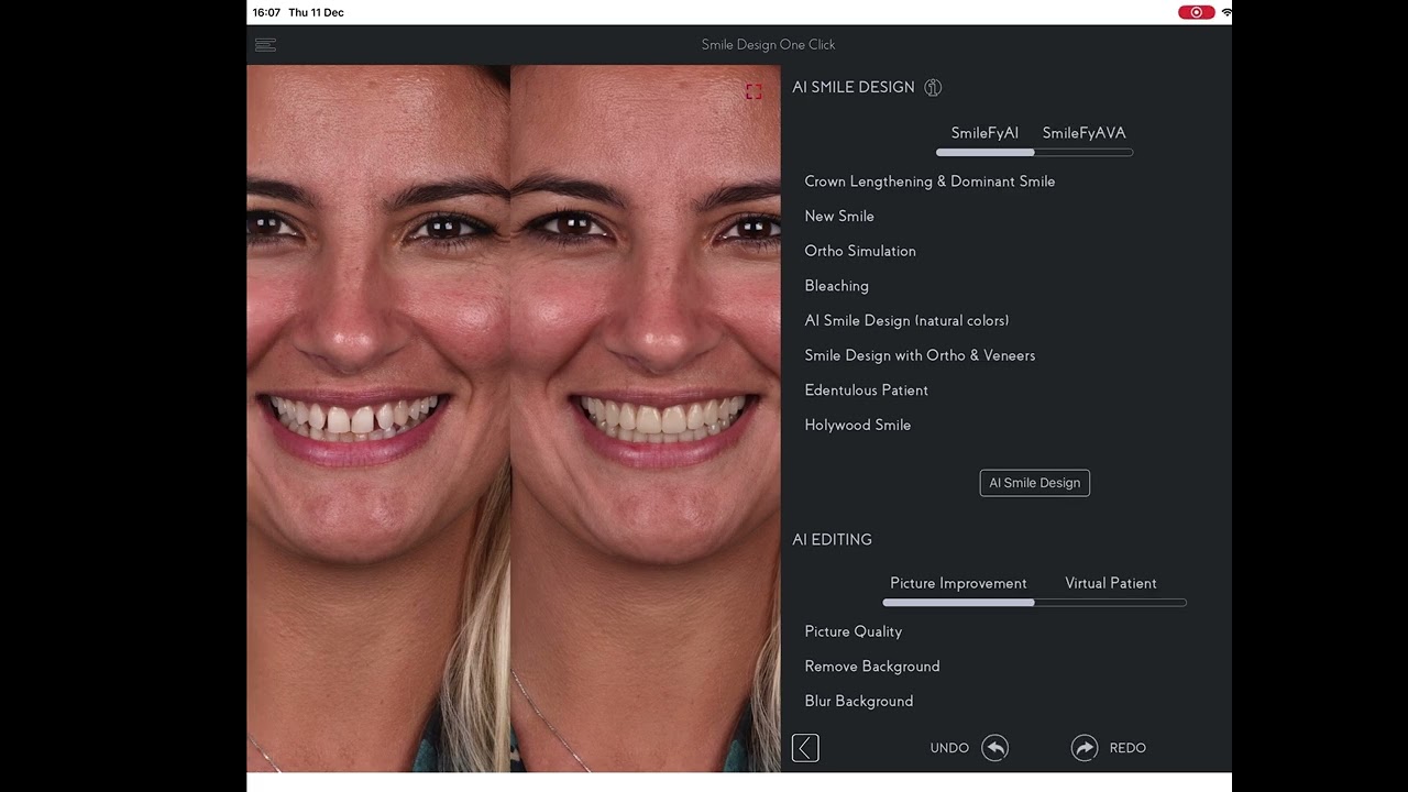 Smilefy Overview: From ONE-CLICK AI Smile Simulation to 3D Print-Ready Treatment Plan