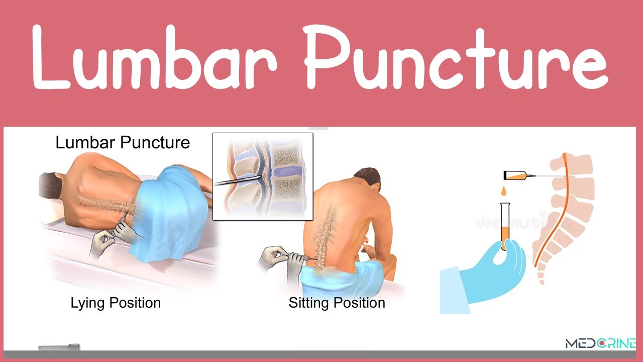Lumbar Puncture (Spinal Tap) Explained | Anatomy, Procedure, Indications and Contraindications