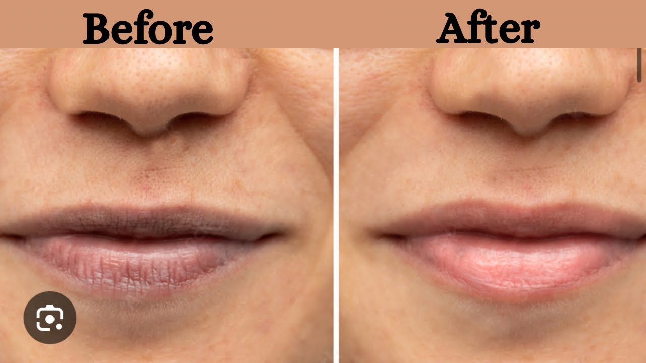 How to get rid of lip pigmentation | best lip balm for pigmented lips 📍👄 📍