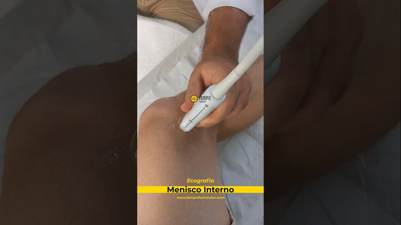Rotura menisco interno y ecografia #ecografia #fisioterapia