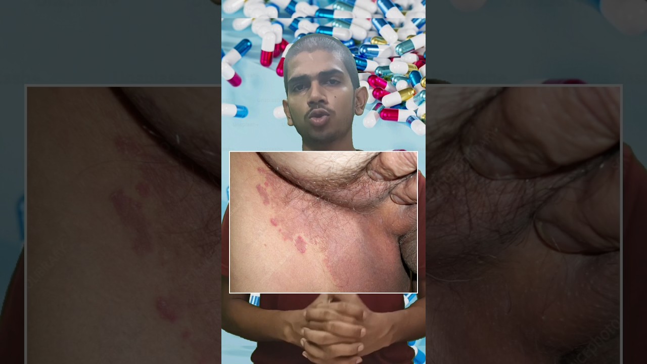 kt5 derm cream use in hindi | दाद खाज खुजली की दवा | 🥶 #kt5dermcream #short #viral