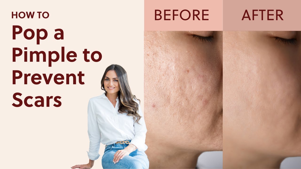 How to Pop A Pimple To Prevent Scarring