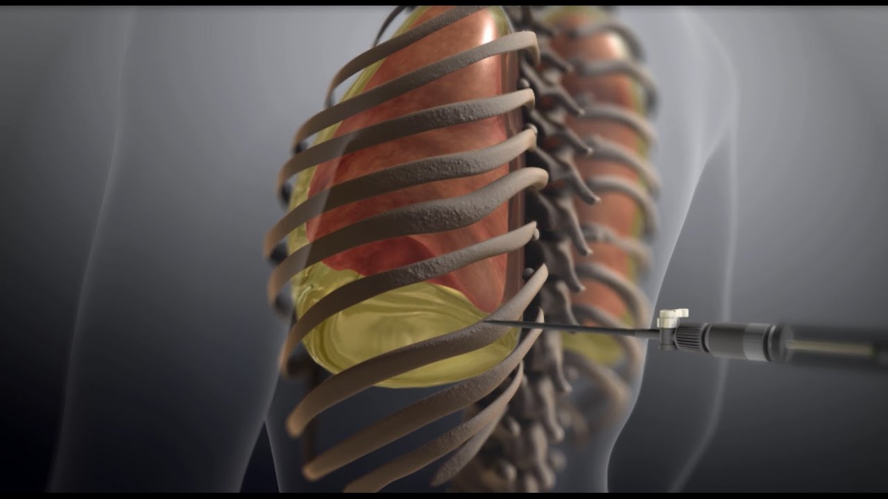 Thoracentesis