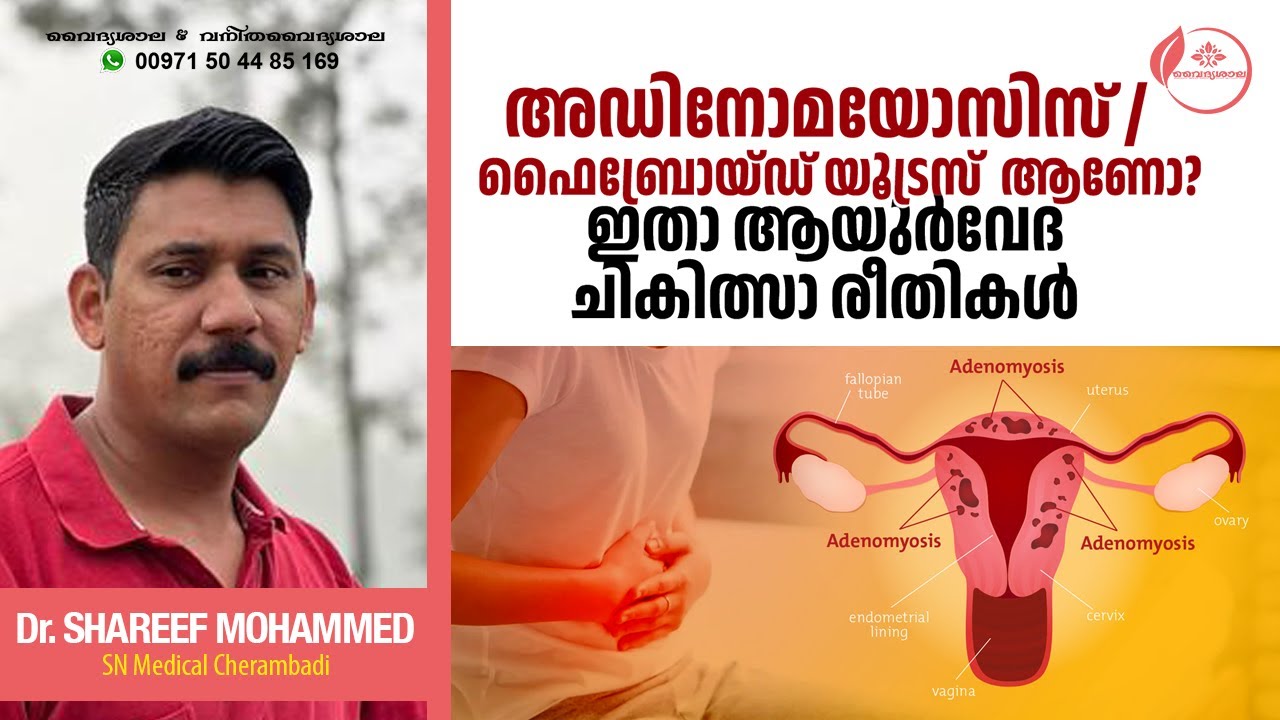 Adenomyosis Malayalam | Adenomyosis Ayurvedic Treatment | അഡിനോമയോസിസ്  | Dr Shareef