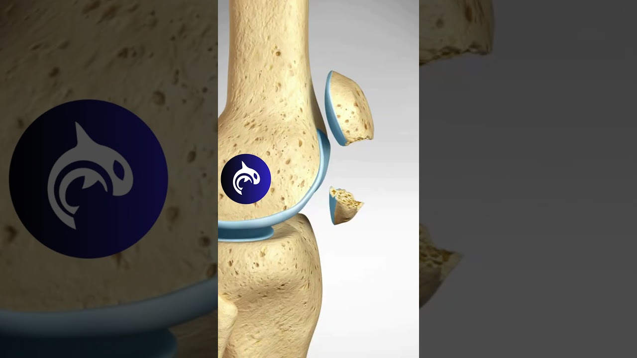 How do you fix Broken Knee Cap? See a Patellar Fracture & Fixation