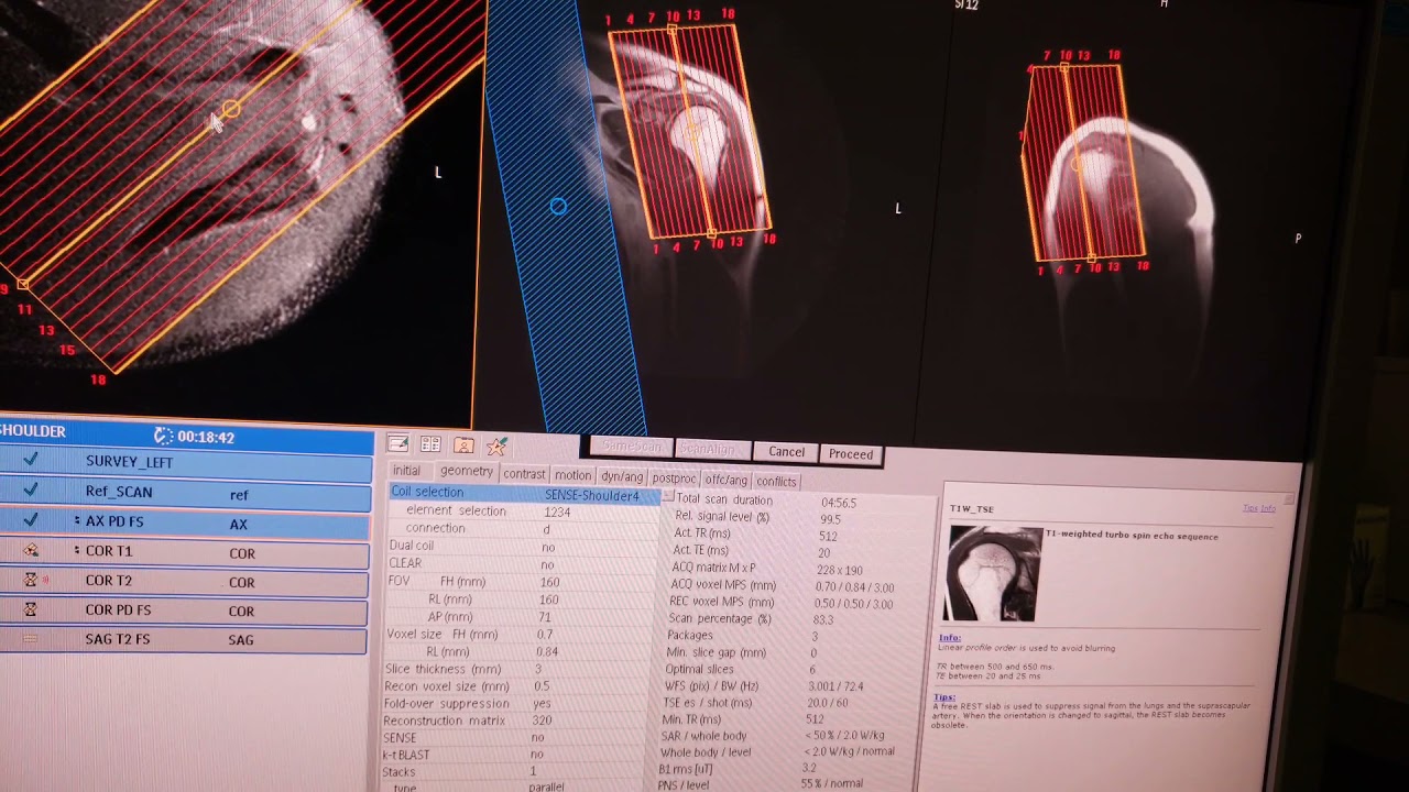 Preventing Shoulder Flipping in MRI