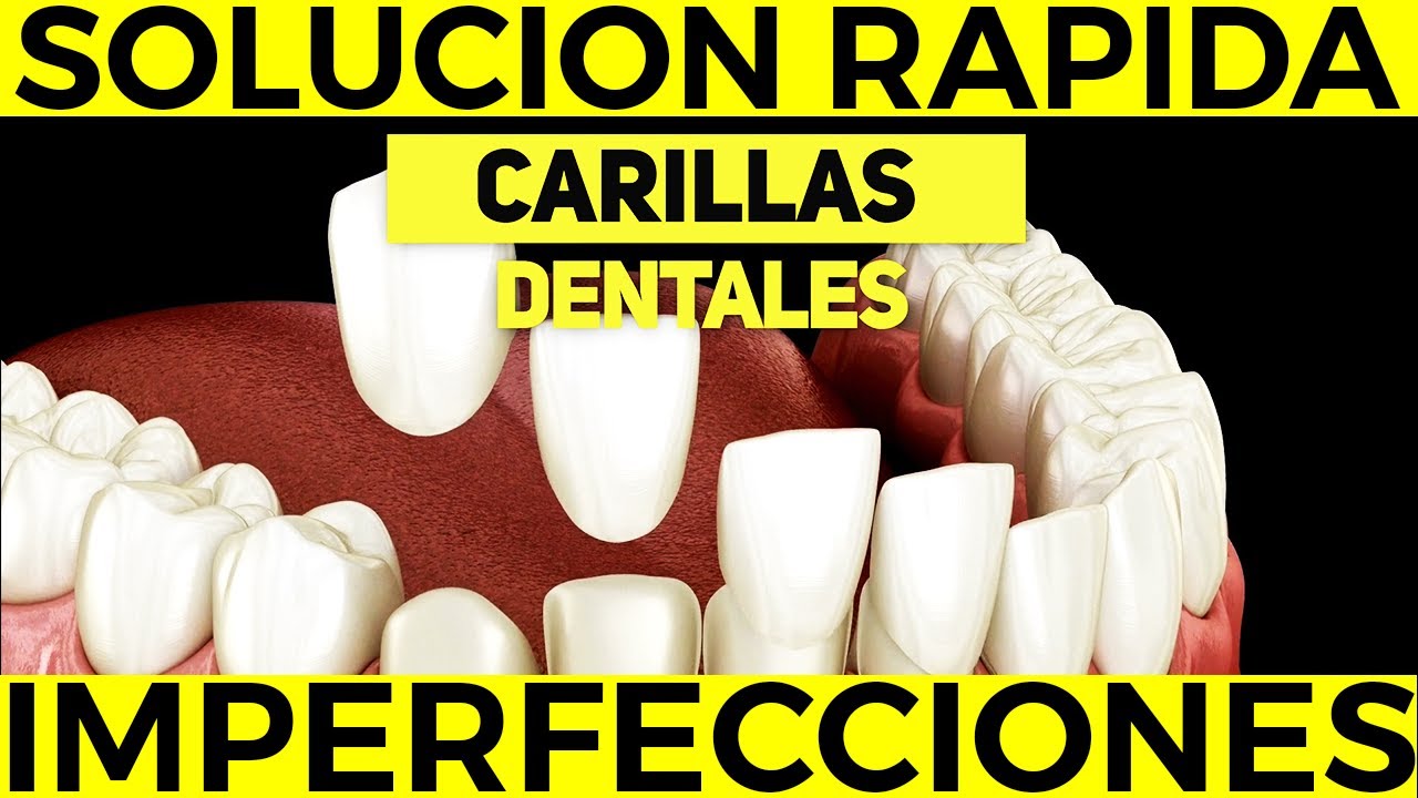 ¿Cómo CERRAR los espacios entre los DIENTES SEPARADOS sin ortodoncia? Junta tus DIENTES sin Brackets