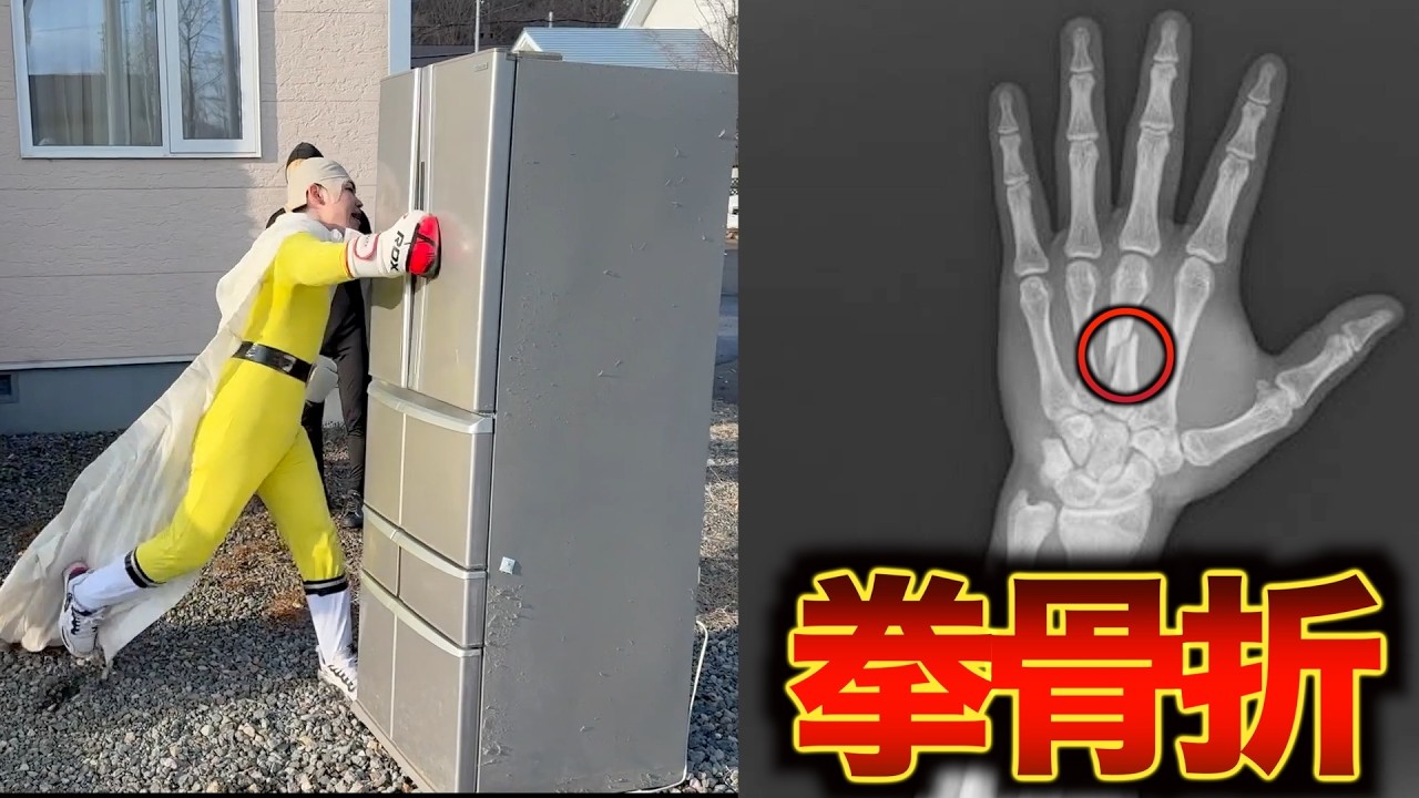 ワンパンマンチャレンジで拳の骨が折れました。