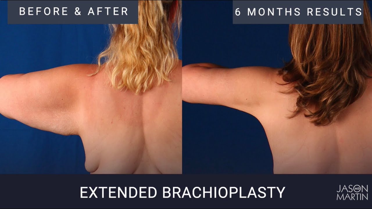 Armlift options and alternative treatments