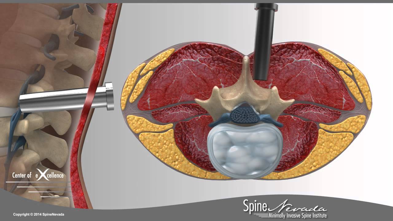 Lumbar Laminotomies at Swift Institute - Reno, Carson City - Spine Neurosurgery