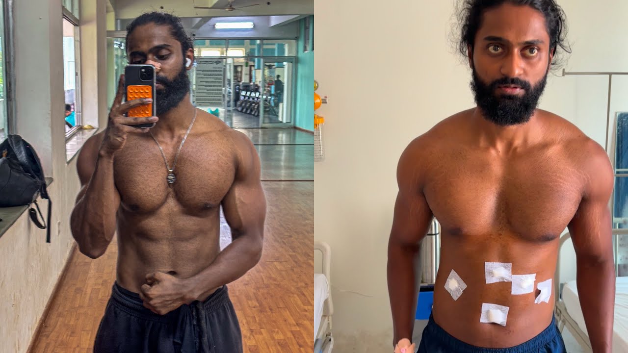 Hiatal Hernia & Acid Reflux & Nissen Fundoplication Post Surgery.