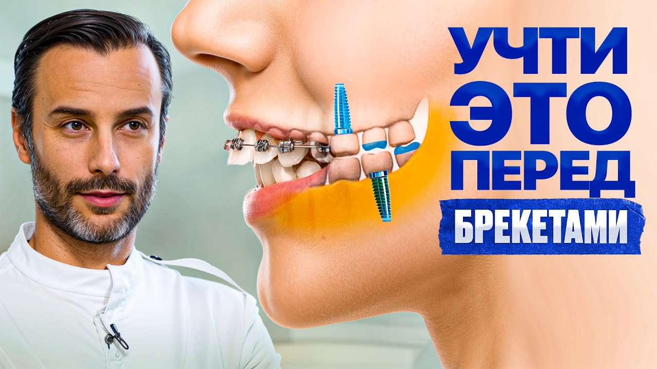 5 рекомендаций ортодонта перед установкой брекетов