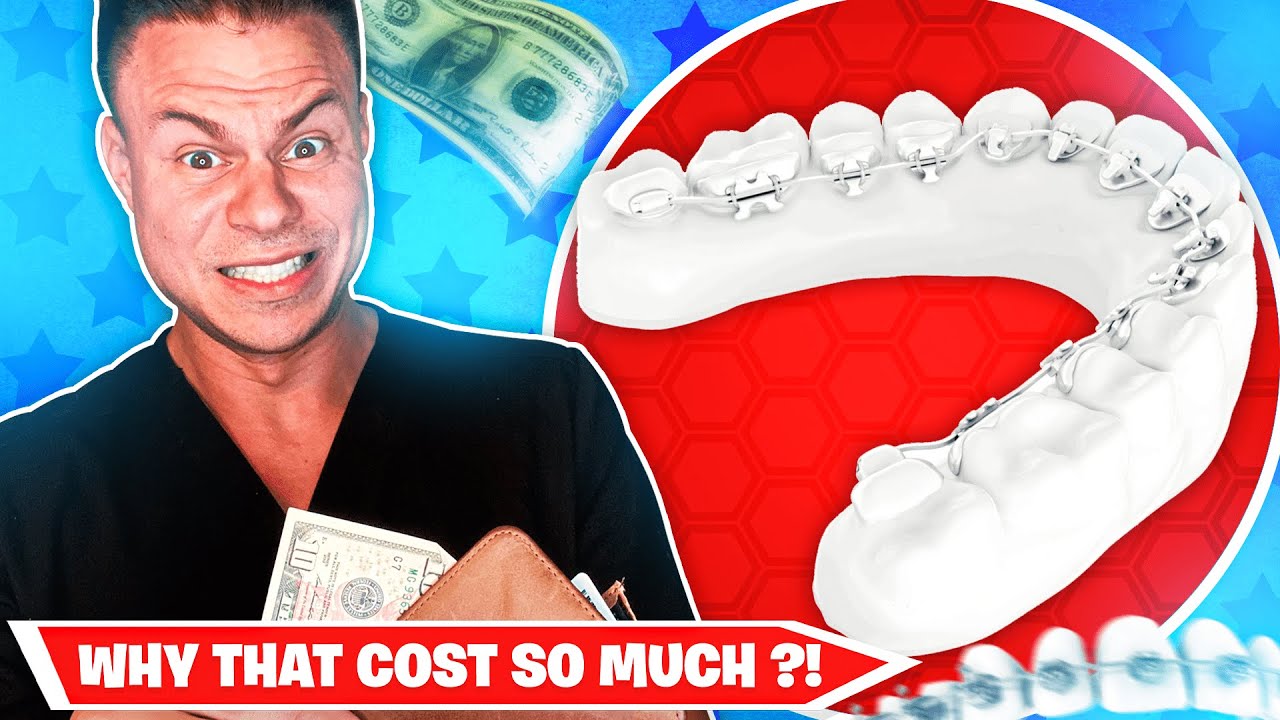 Why BRACES Cost So Much... The TRUTH