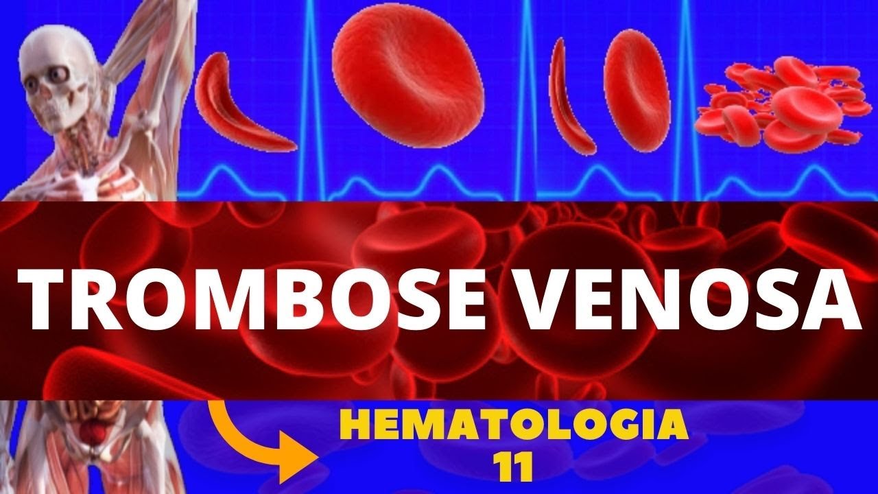 TROMBOSE VENOSA PROFUNDA (FORMAÇÃO DE COÁGULO) - HEMATOLOGIA (TVP)