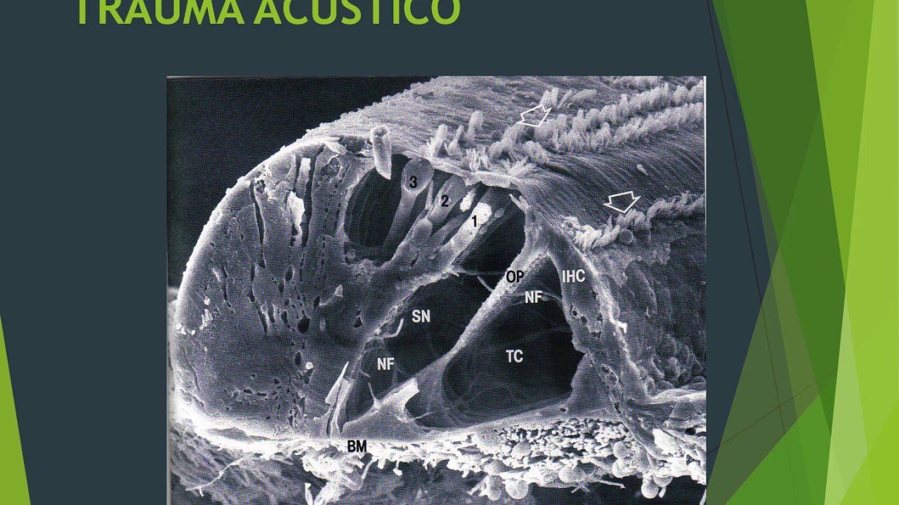 trauma acústico