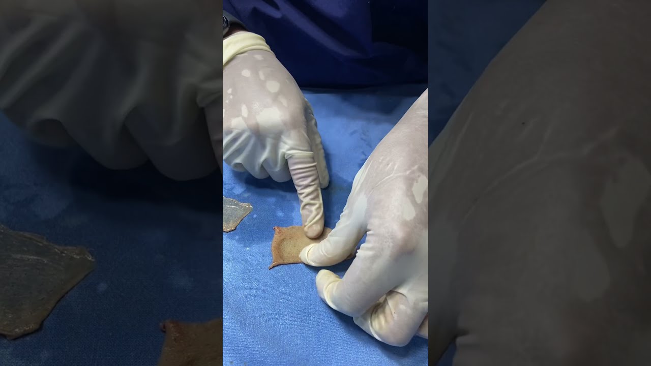 Type of skin grafts. Basic info