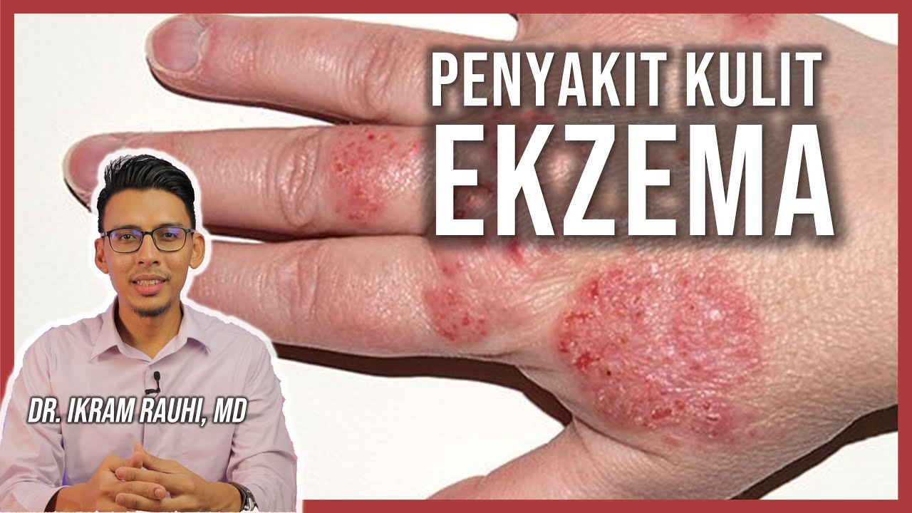 Ekzema (Eczema) - Apa Yang Anda Patut Tahu : Punca dan Penyebab | Ubat Ekzema | Bayi dan Dewasa
