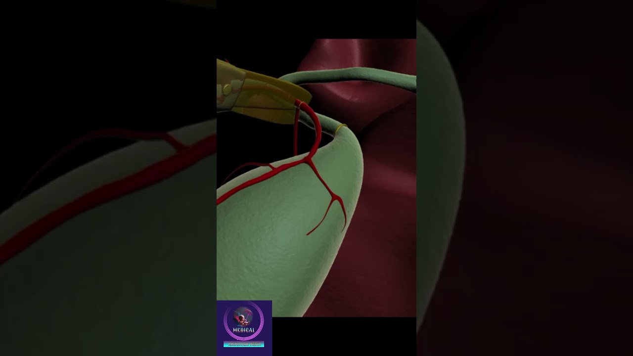 Laparoscopic Cholecystectomy Procedure #short