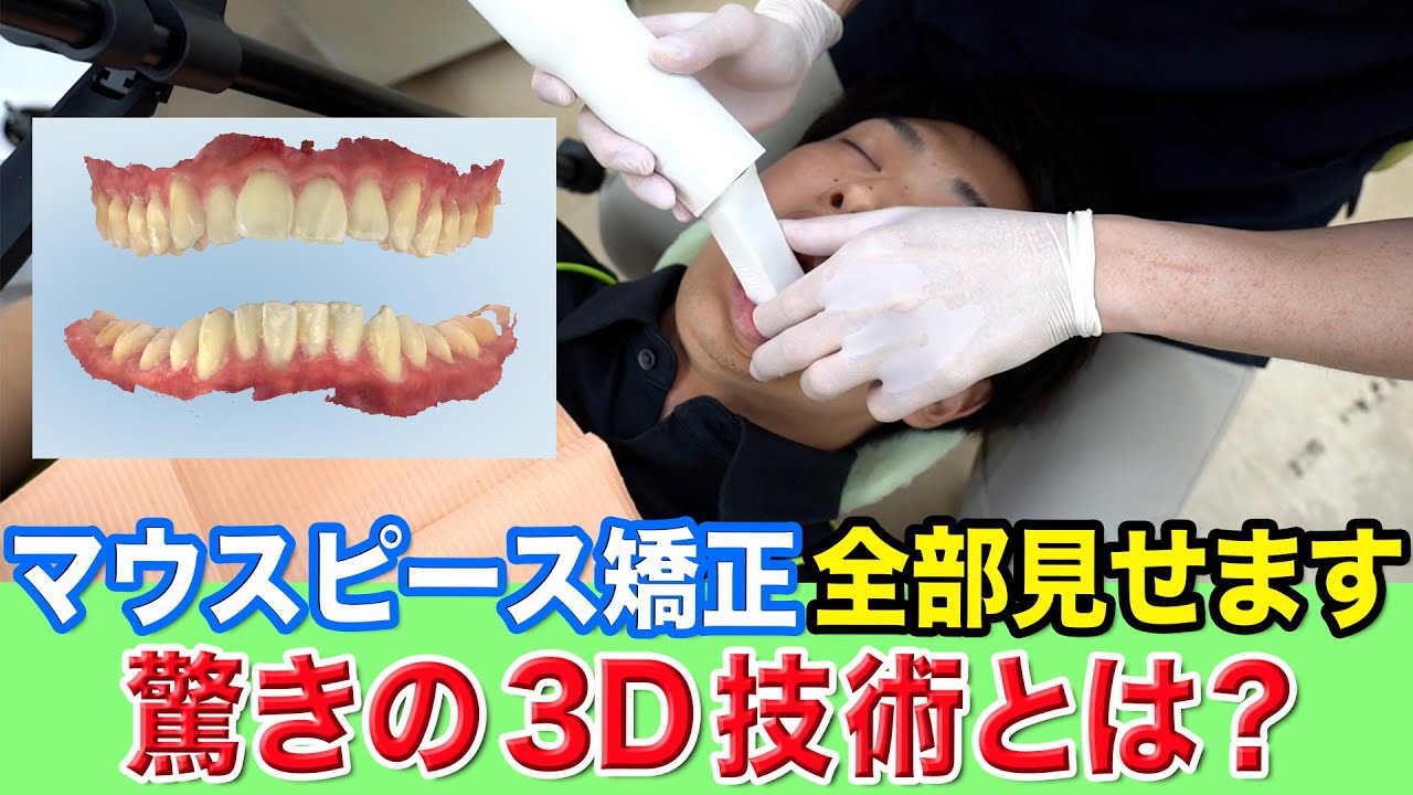 【歯列矯正】マウスピース矯正をスタッフが始めてみた!