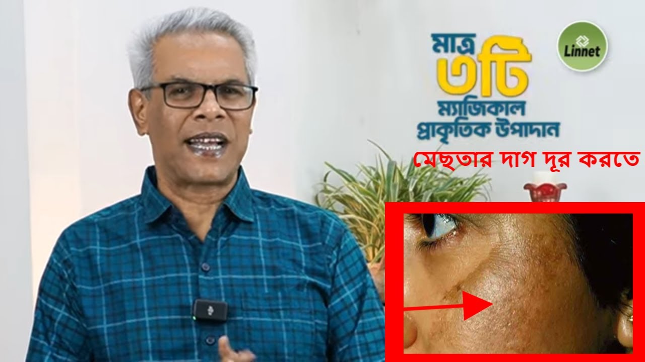 মেছতার দাগ দূর করার উচ্চমাত্রার ৩টি প্রাকৃতিক উপাদান Melasma Treatment at Home