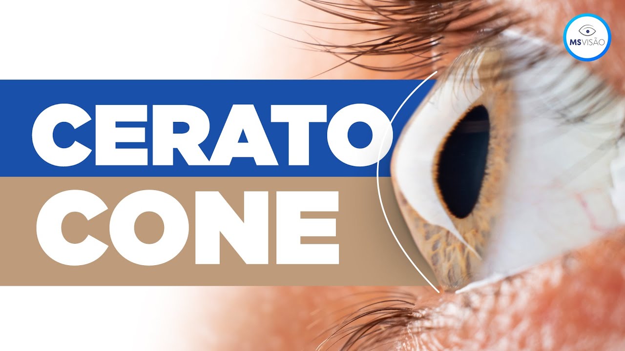 O Que É Ceratocone ? Quais as Causas e Tratamento Do Ceratocone? - Oftalmologista Explica