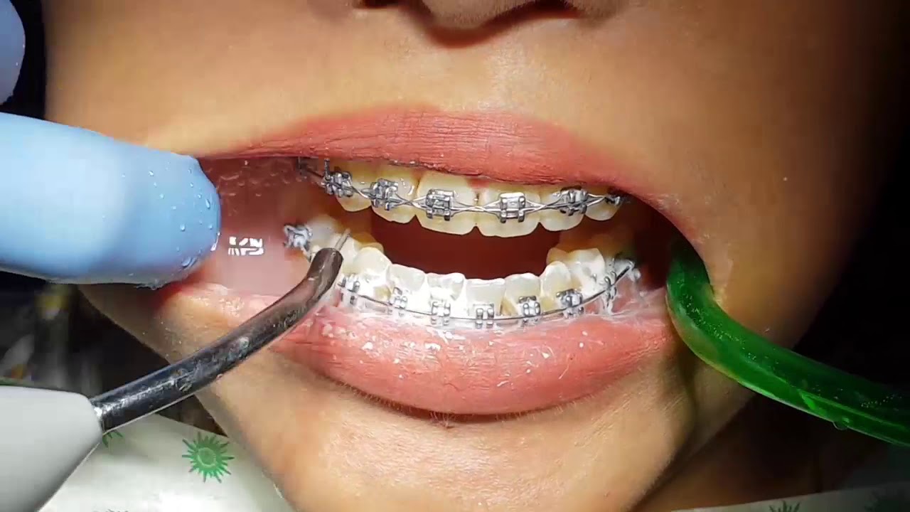 Kontrol Ortho (Kawat Gigi) Rutin