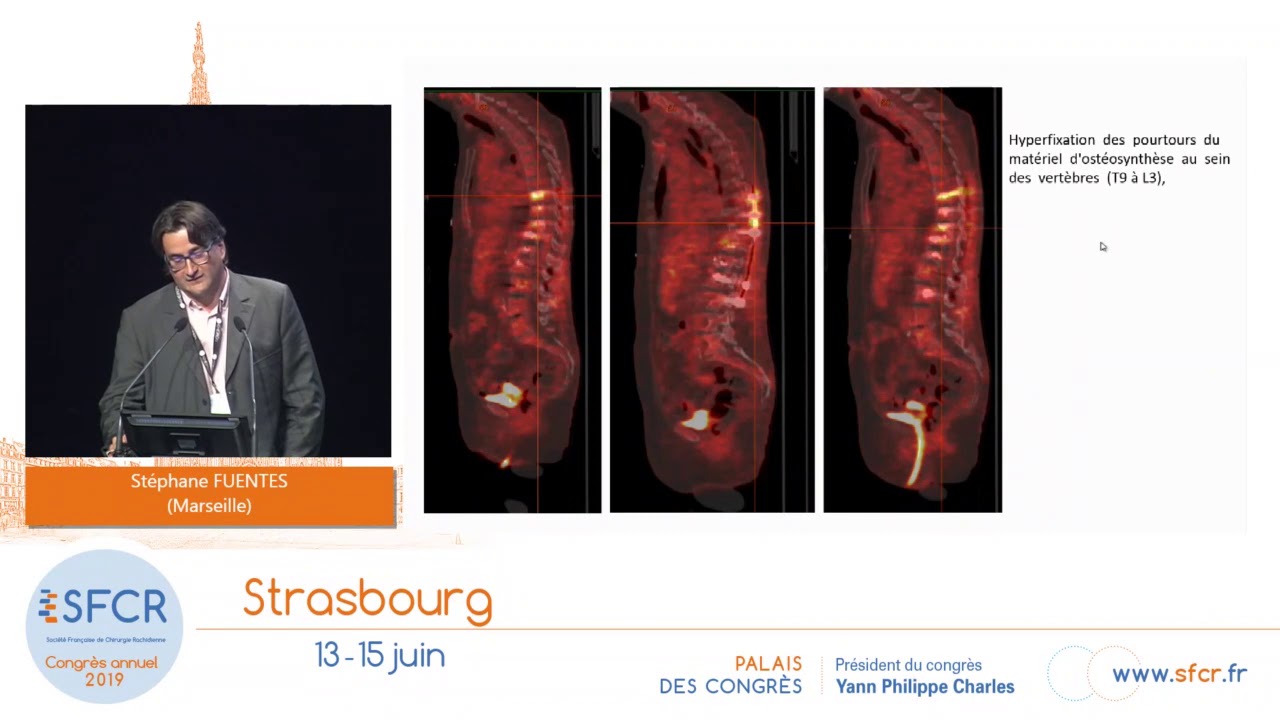 Bilan radiographique en cas de suspicion d’infection de site opératoire. S. Fuentes (Marseille)