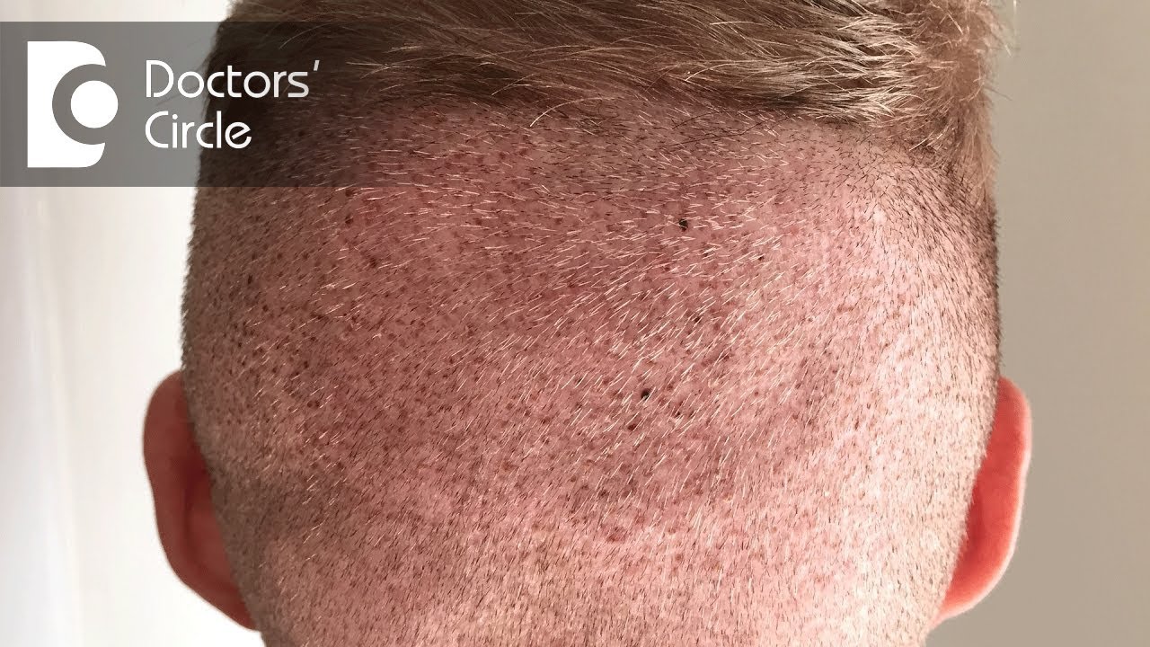 Can Follicular Unit Extraction be performed? - Dr. K Prapanna Arya