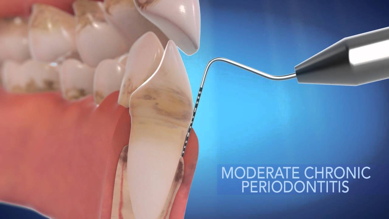 Straight Talk About Crooked Teeth