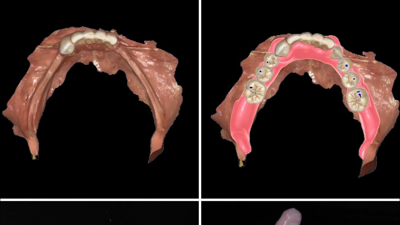 3D printed Dentures