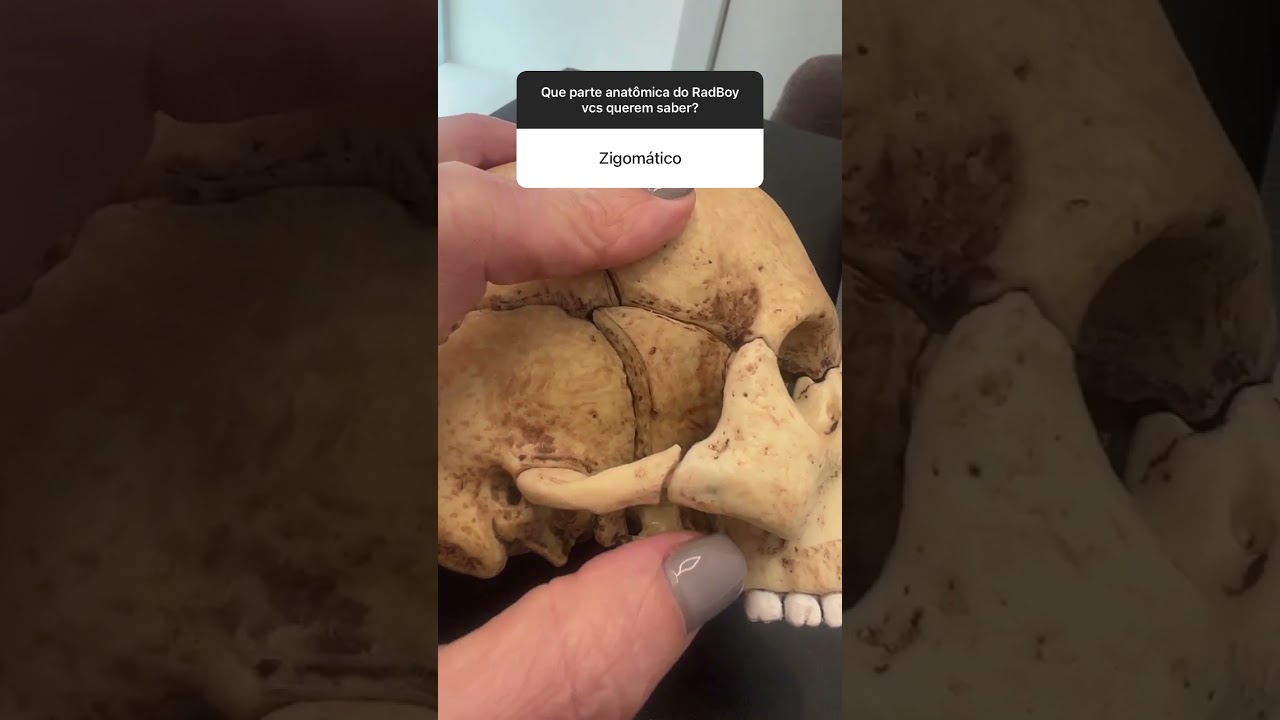 Osso zigom&aacute;tico