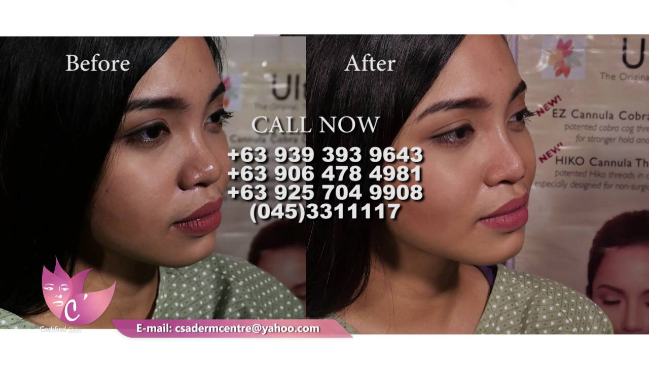 nonsurgical noselift using RESTYLANE PERLANE DERMAL FILLER