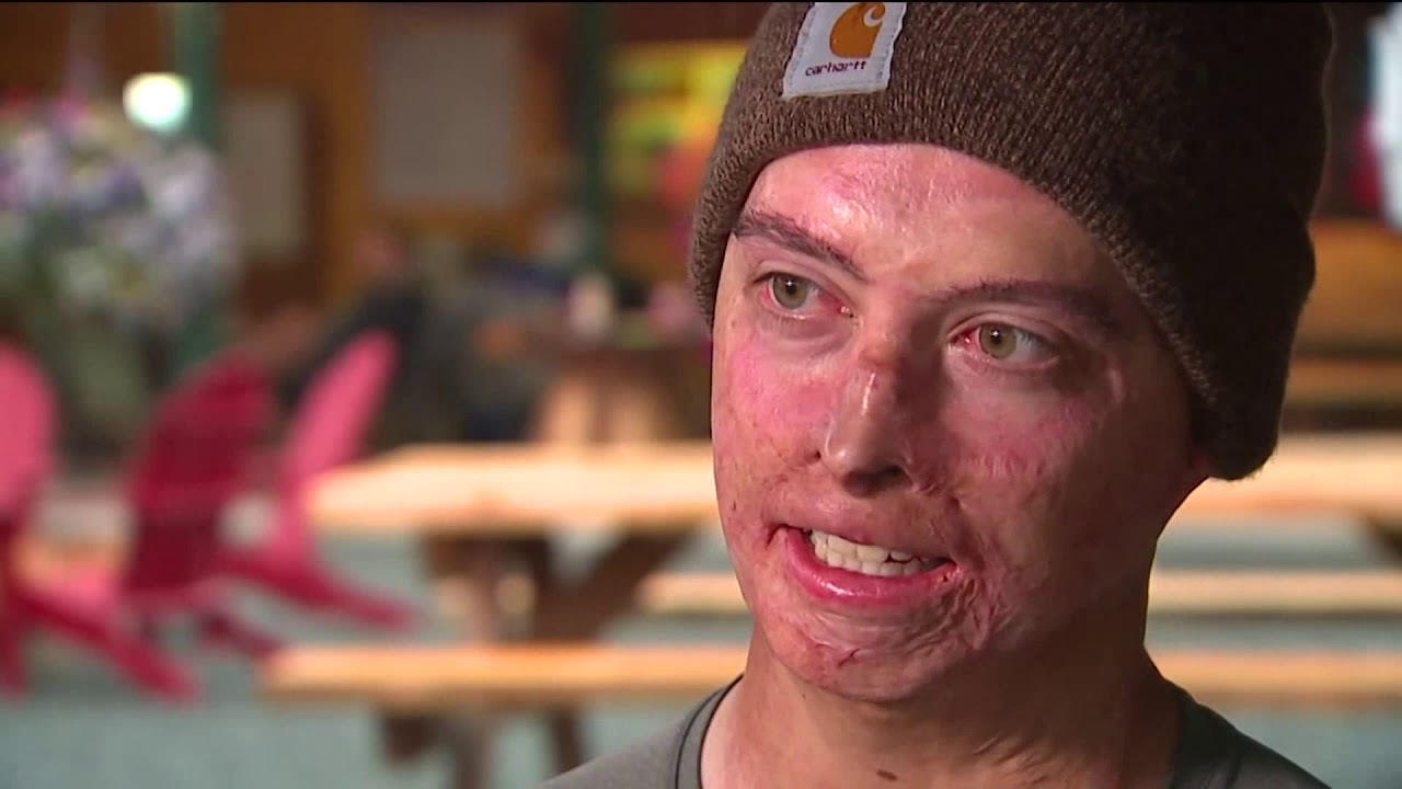 'It Took Literally Everything in Me': Fire Survivor Reaches Summit in Washington