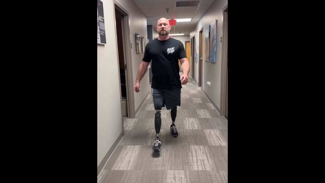 Bilateral Above Knee Amputee Walking Without Cane | Advanced Prosthetic Legs Training