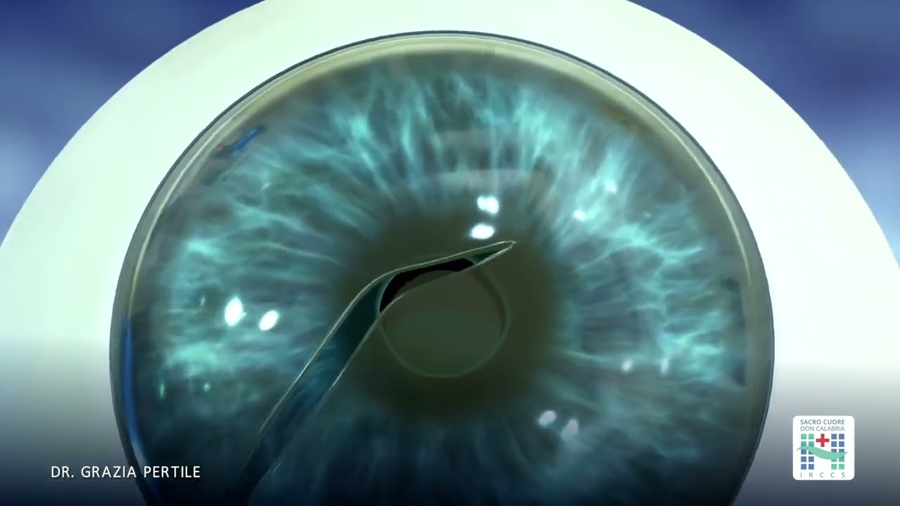 Eye surgery: mastering corneoscleral wound suturing technique
