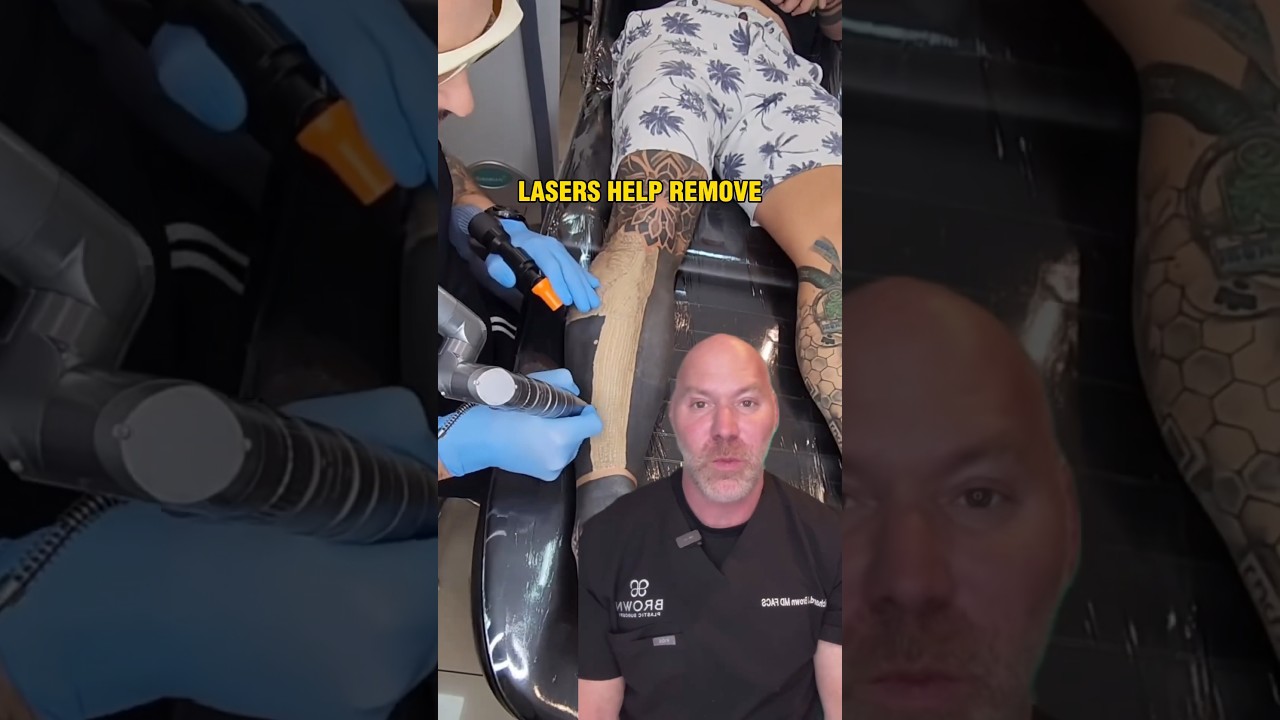 How Laser Tattoo Removal Works 💥