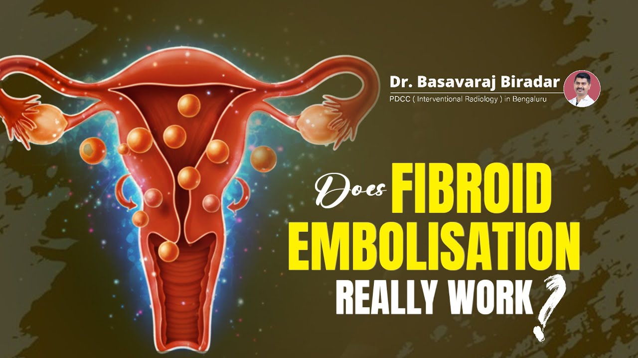 Real-Life UFE Results With MRI Proof | Fibroid Treatment Without Surgery? | In Karnataka
