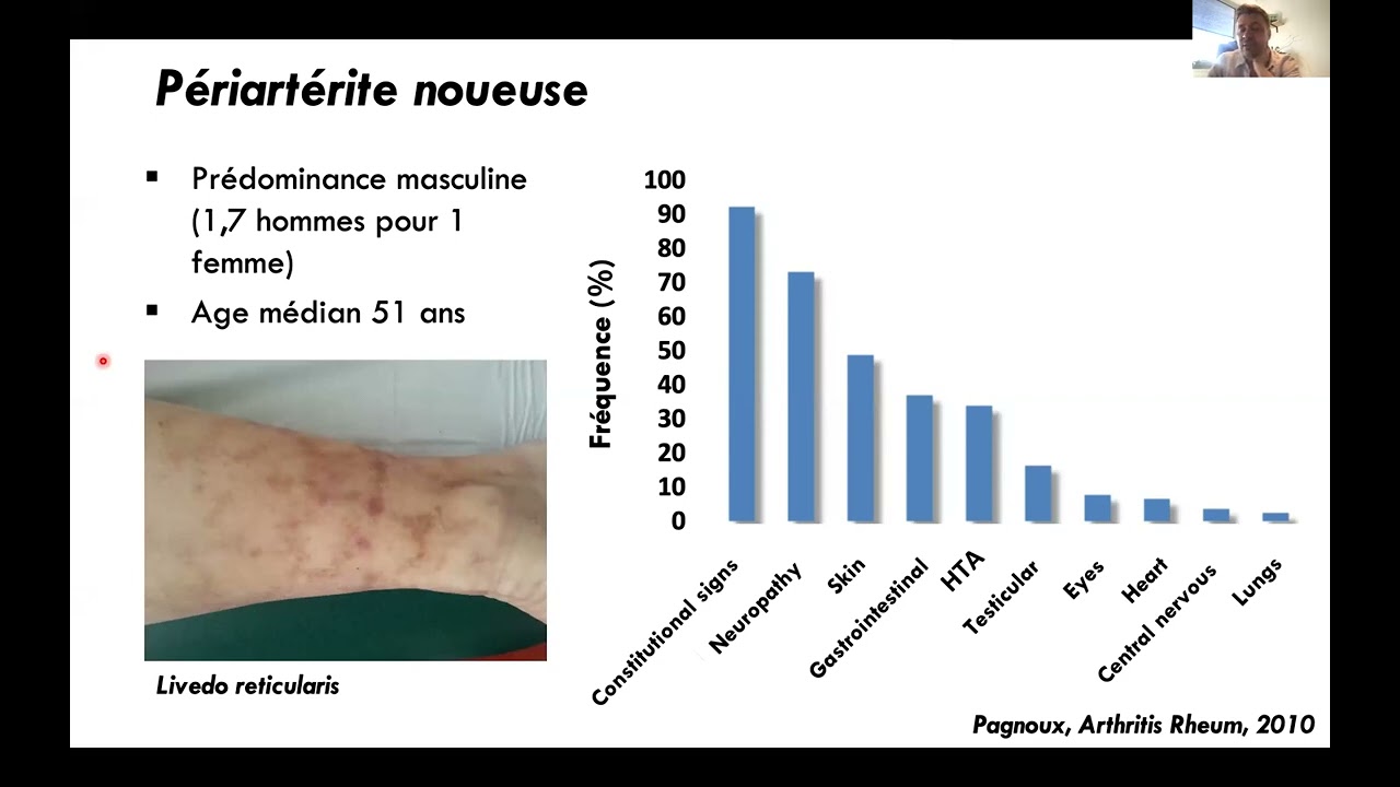 Périartérites noueuses