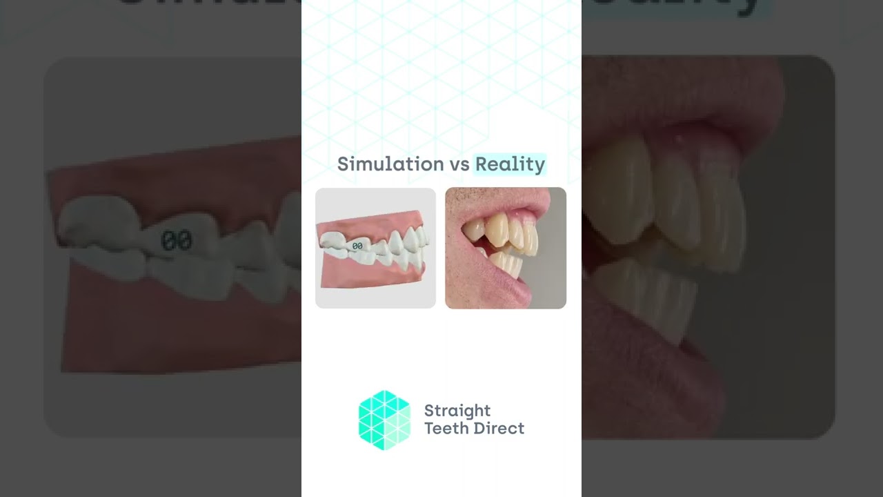 Simulation vs Reality - clear aligners edition #shorts
