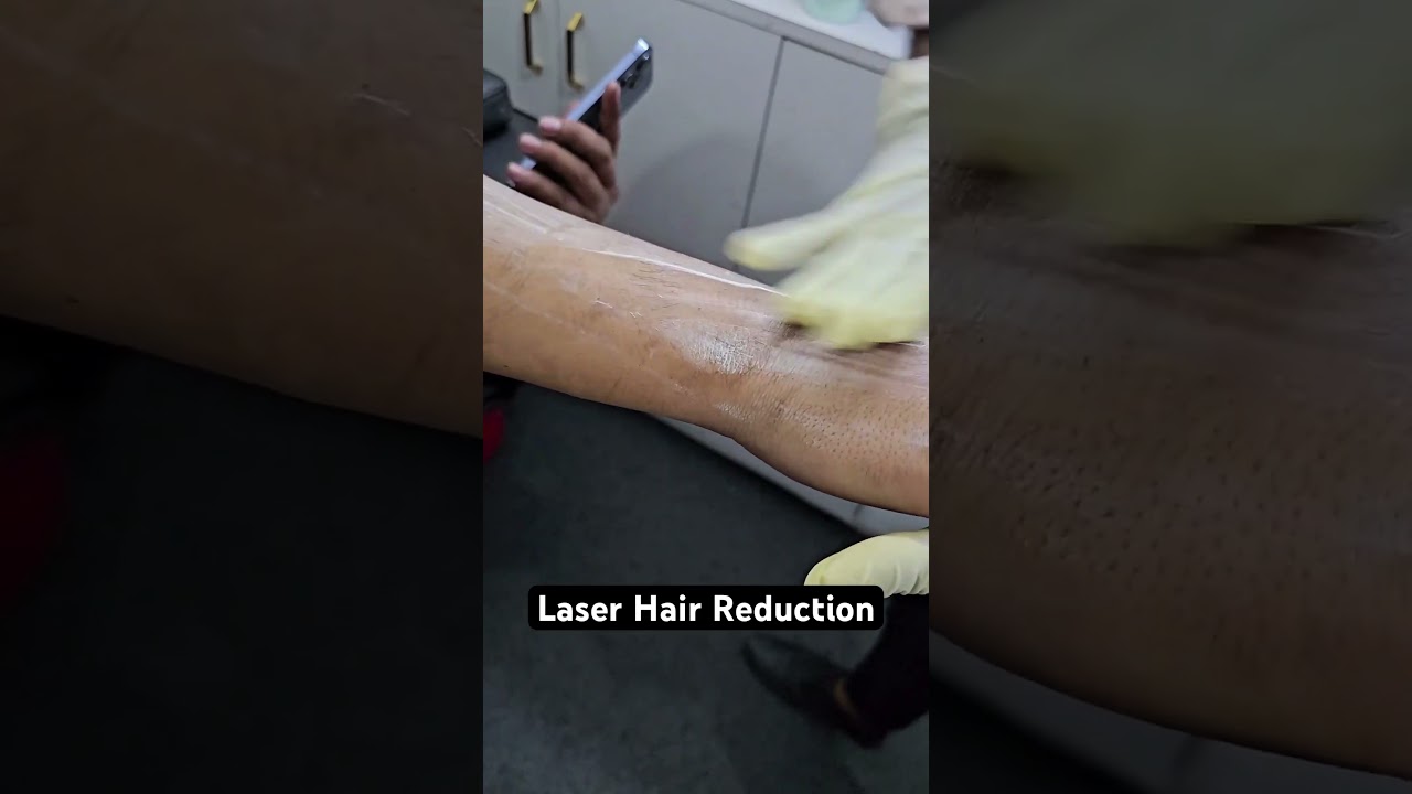 Laser Hair Reduction 