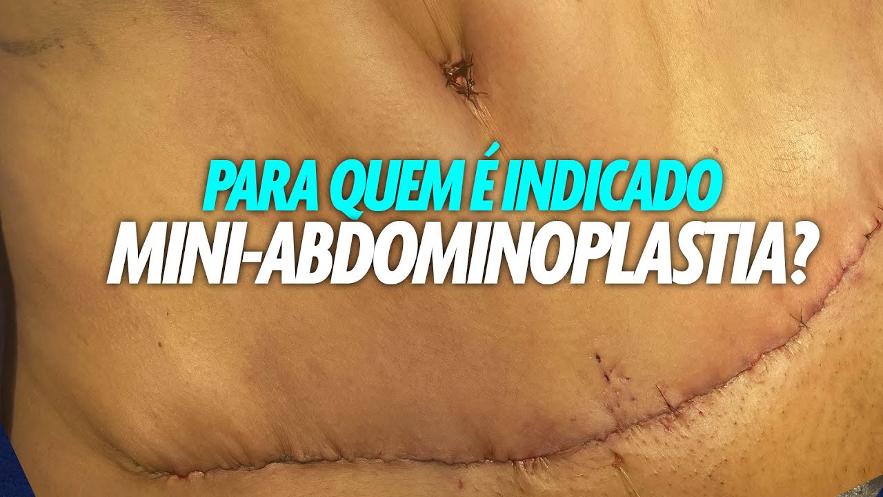 PARA QUEM É INDICADO MINI ABDOMINOPLASTIA? CIRURGIA PLASTICA